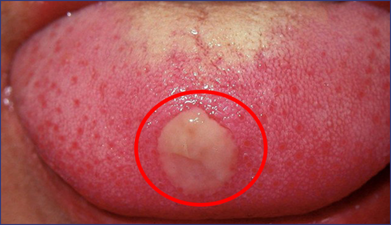 Dấu hiệu nhiệt lưỡi