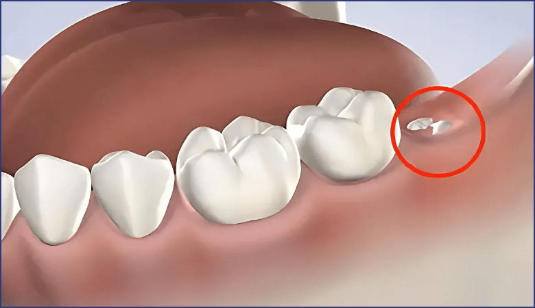 Đau răng do mọc răng khôn