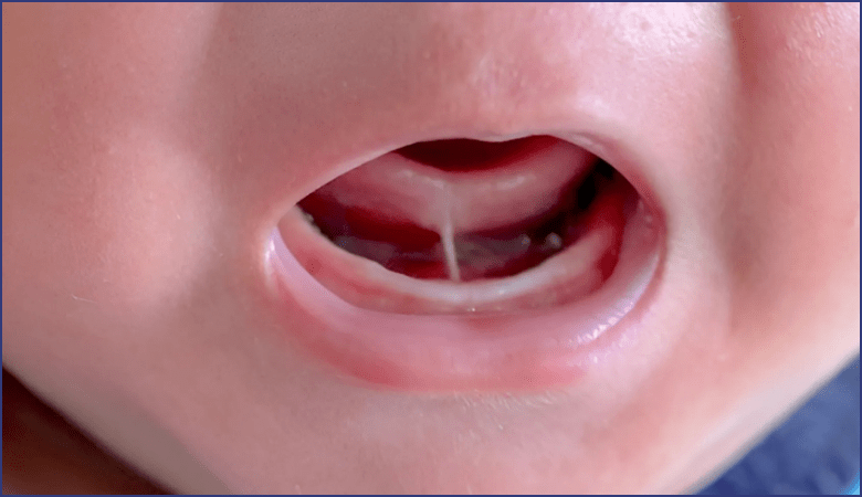 Dính thắng lưỡi là gì