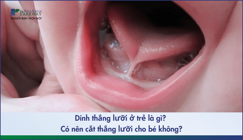 Dính thắng lưỡi là gì? Có nên cắt thắng lưỡi cho bé