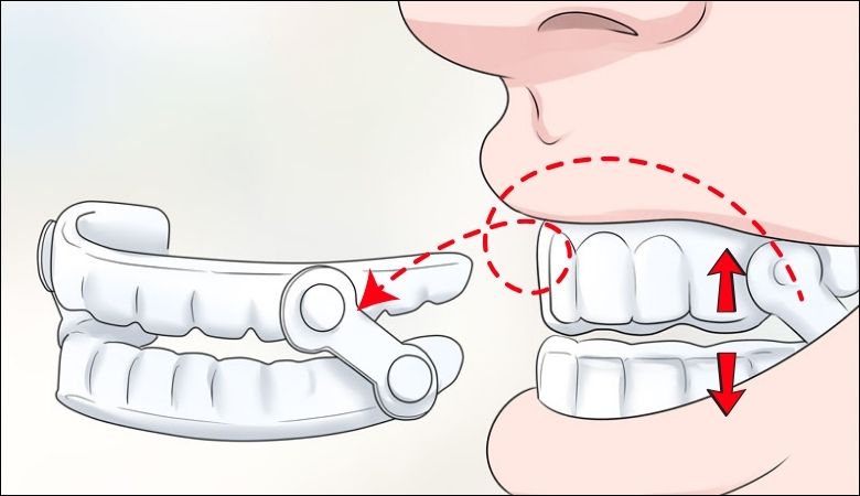 Cơ chế hoạt động của máng chống nghiến răng