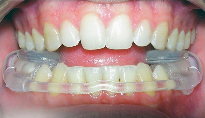 Máng chống nghiến răng giúp bảo vệ men răng khỏi bị mài mòn