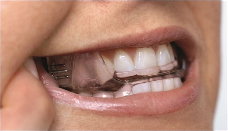 Máng chống nghiến răng nhựa cứng