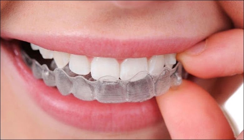 Máng chống nghiến răng được thiết kế riêng