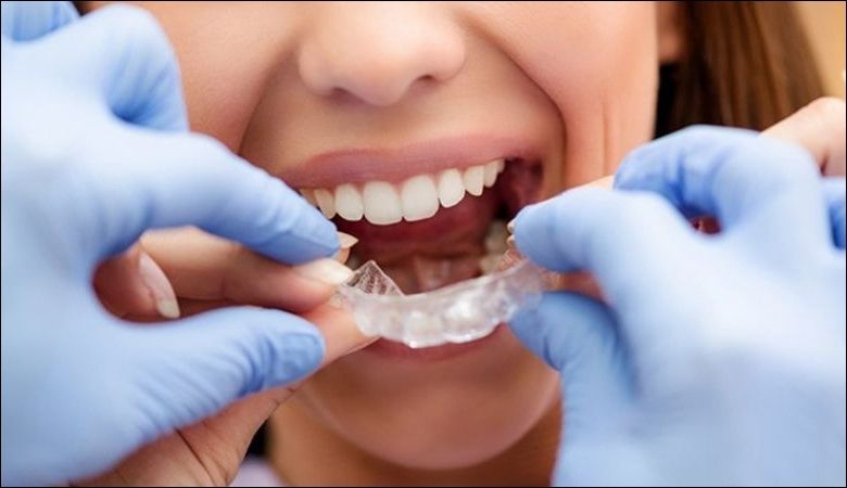 Cách đeo và tháo máng chống nghiến răng