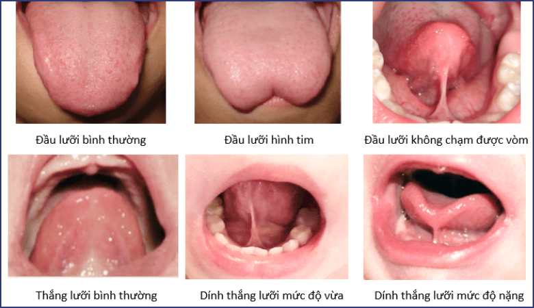 Những mức độ dính thắng lưỡi ở trẻ