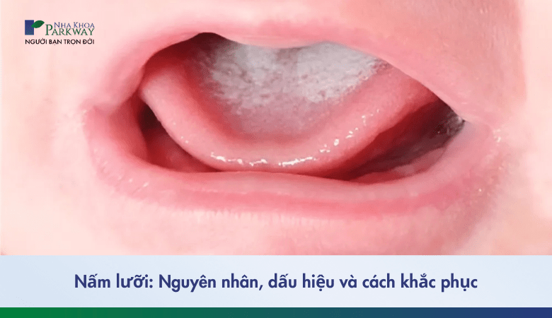 Nấm lưỡi: Nguyên nhân, dấu hiệu và cách khắc phục