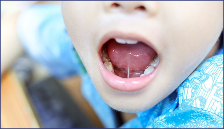 Nguyên nhân dính thắng lưỡi