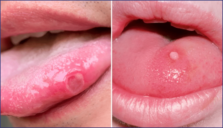 Nguyên nhân gây nhiệt lưỡi