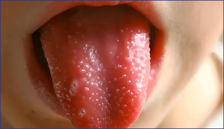 Viêm gai lưỡi là gì