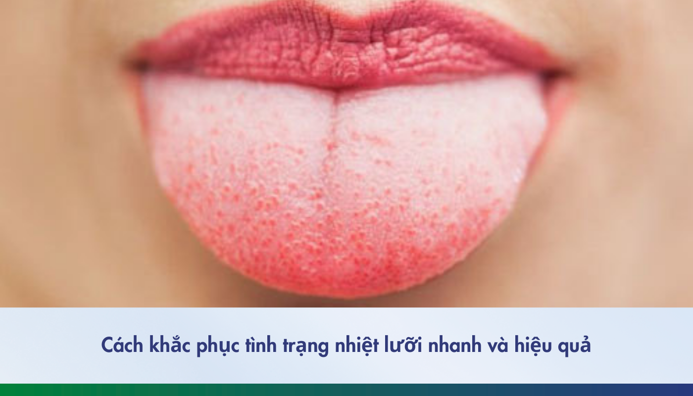 Nhiệt lưỡi: Nguyên nhân, dấu hiệu và cách phòng ngừa