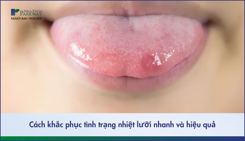 Nhiệt lưỡi và cách khắc phục