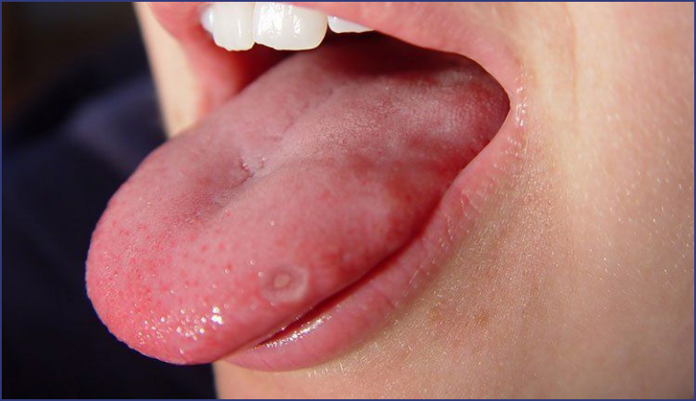 Nhiệt lưỡi là gì