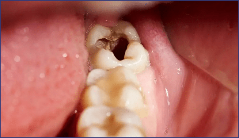 nhức răng có lỗ là tình trạng gì