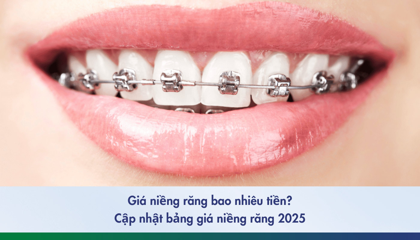 giá niềng răng bao nhiêu tiền - 1
