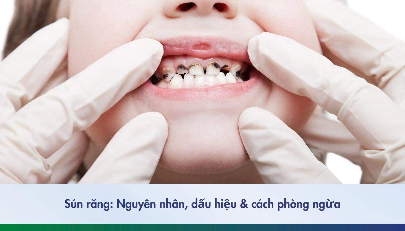 Sún răng là gì? Tổng quan về bệnh sún răng