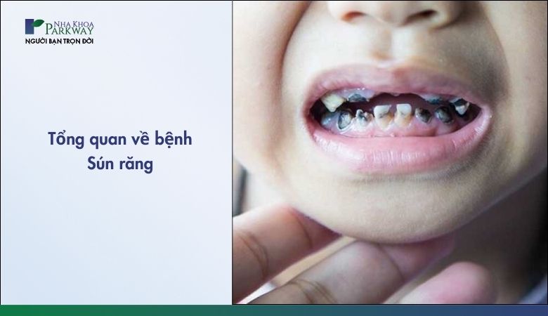 Tìm hiểu về bệnh sún răng