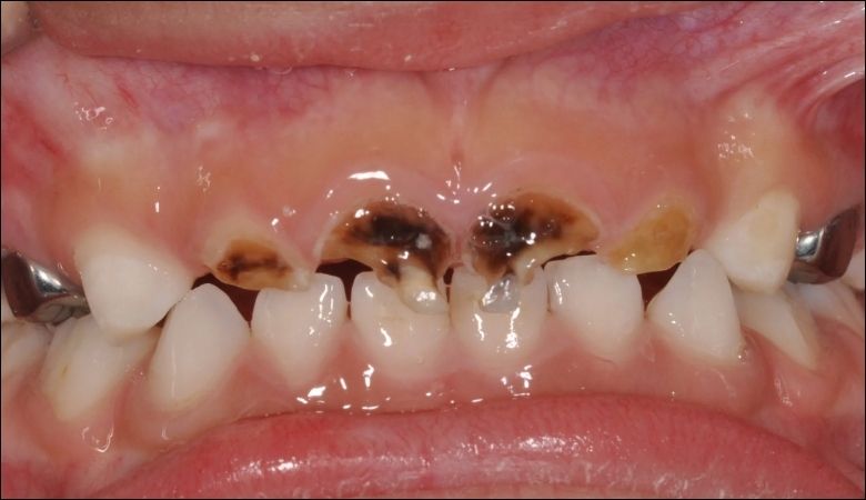 Sún răng là tình trạng men răng mất khoáng dẫn đến tổn thương