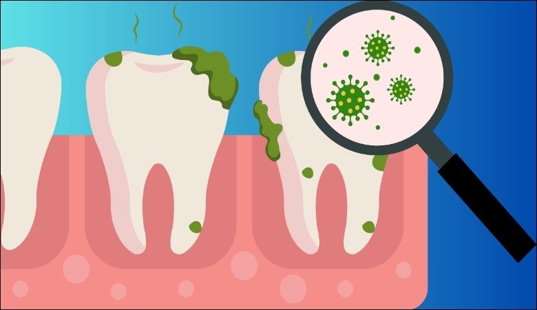 Vệ sinh răng miệng không đúng cách là nguyên nhân hàng đầu gây bệnh sún răng