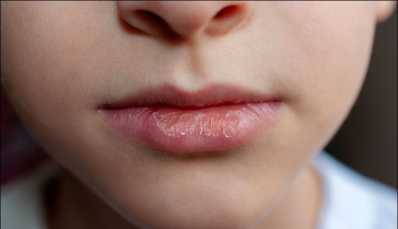 Khô miệng tạo điều kiện để vi khuẩn phát triển và gây sún răng