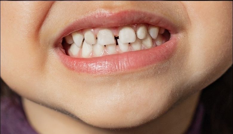 Răng chuyển sang màu trắng đục hoặc vàng trong giai đoạn đầu của sún răng