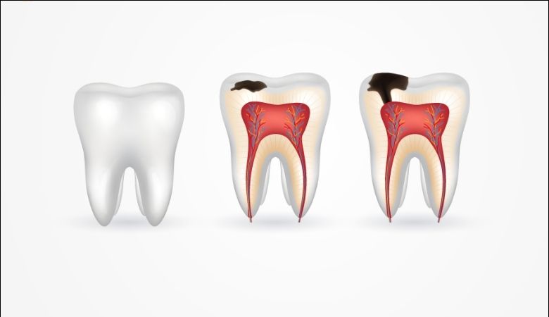 Dấu hiệu sún răng là khi xuất hiện các lỗ nhỏ trên bề mặt răng