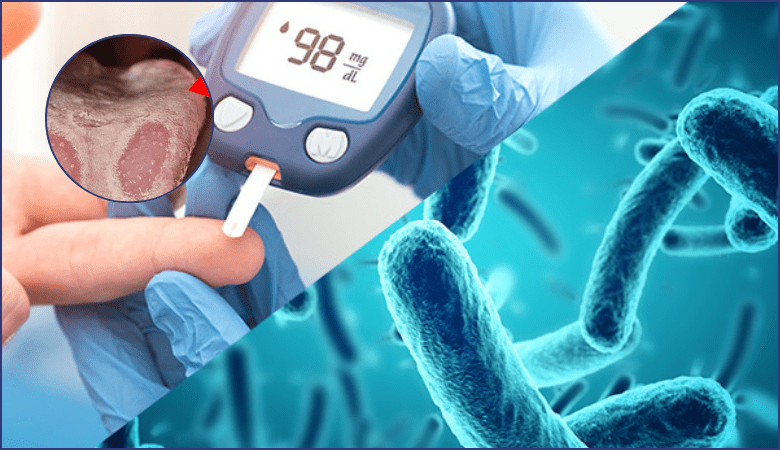 Nguyên nhân nấm lưỡi - 3