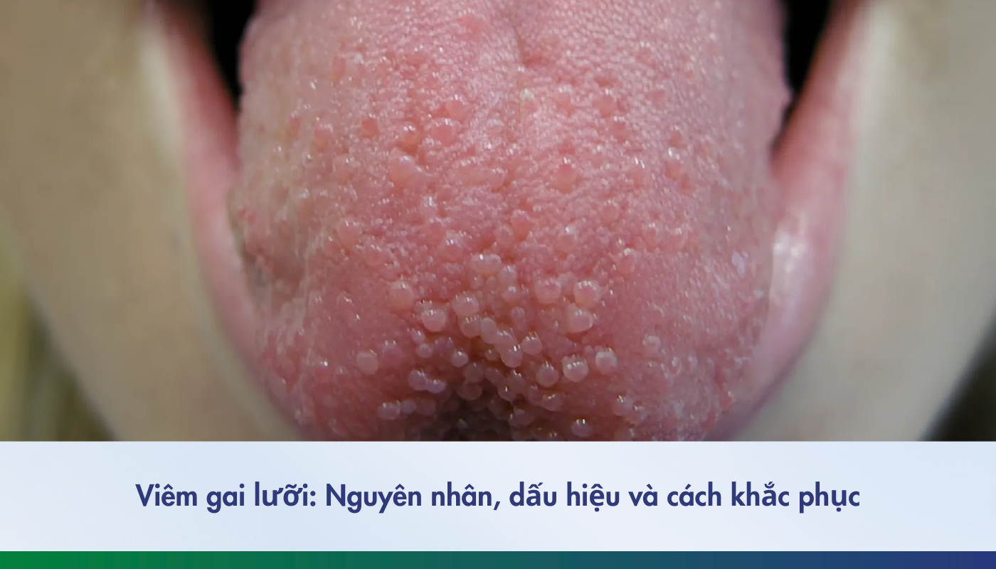 viêm gai lưỡi: Nguyên nhân và cách khắc phục