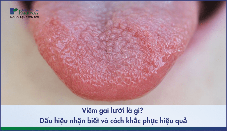 Viêm gai lưỡi là gì và những cách khắc phục