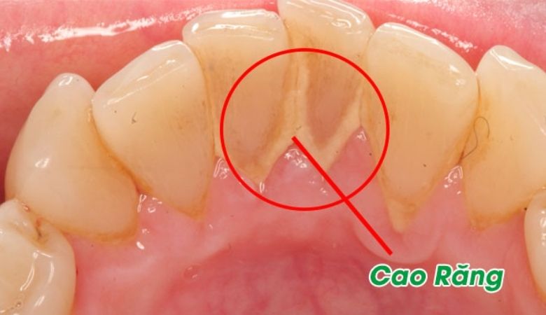 Việc không loại bỏ cao răng kịp thời có thể dẫn đến các vấn đề như viêm nướu hoặc sâu răng