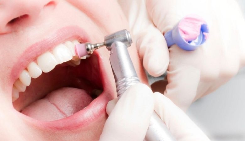 Lấy cao răng có đau không phụ thuộc vào mức độ cao răng, tình trạng răng miệng và kỹ thuật của nha sĩ