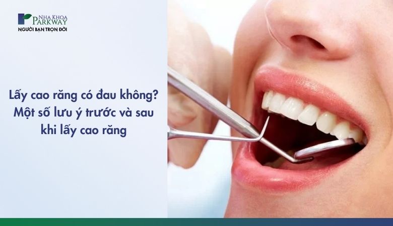 Lấy cao răng là một thủ thuật nha khoa phổ biến nhằm loại bỏ mảng bám cứng trên răng