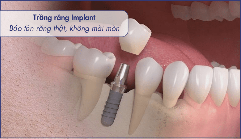 bảo tồn răng thật