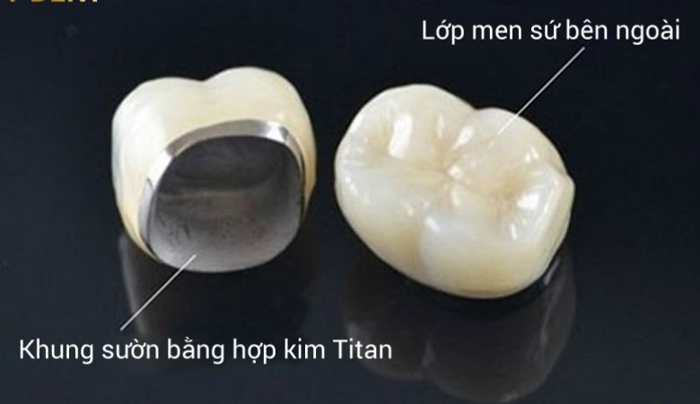 Răng sứ Titan là loại răng sứ có khung sườn bên trong làm từ hợp kim Titanium 