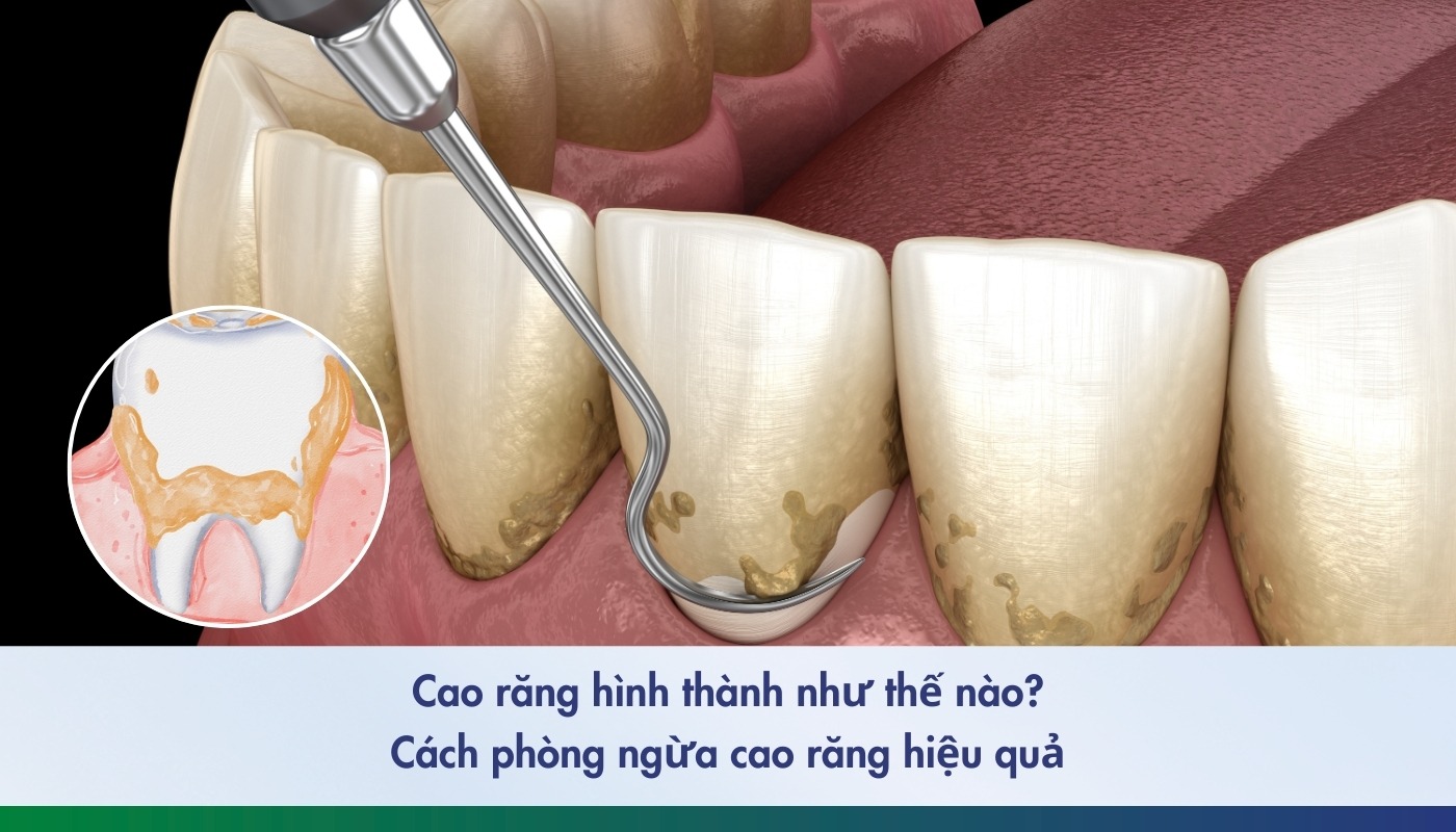 Quá trình hình thành cao răng