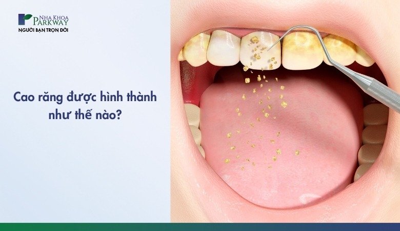 Những cách phòng ngừa cao răng hiệu quả