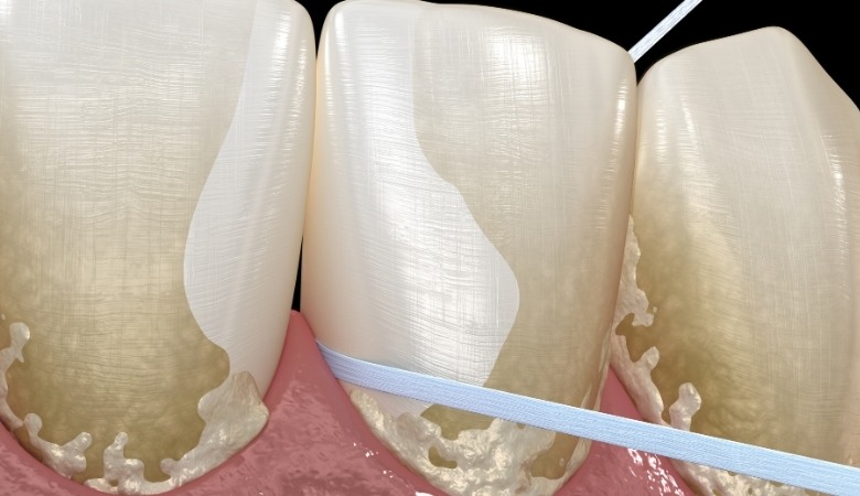 Cao răng là những mảng bám do thức ăn thừa hoặc vi khuẩn bị vôi hóa bám chắc trên bề mặt răng