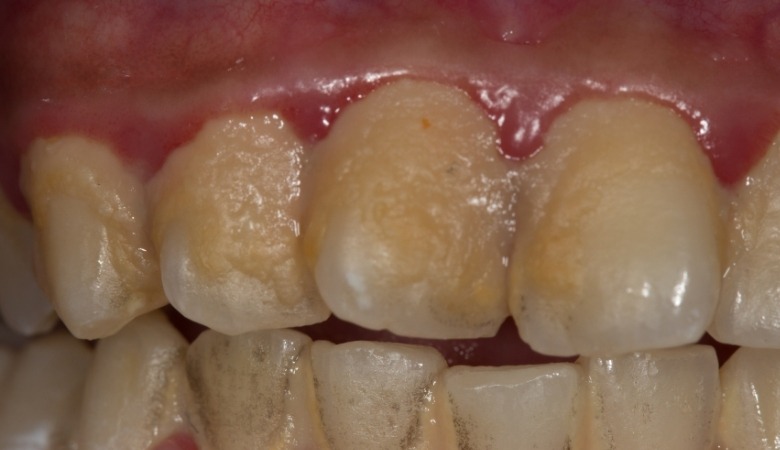 Cao răng được hình thành trong thời gian dài do thói quen vệ sinh răng miệng kém