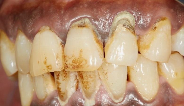 Cao răng có thể gây ra nhiều bệnh lý răng miệng nguy hiểm như viêm nướu hay viêm nha chu