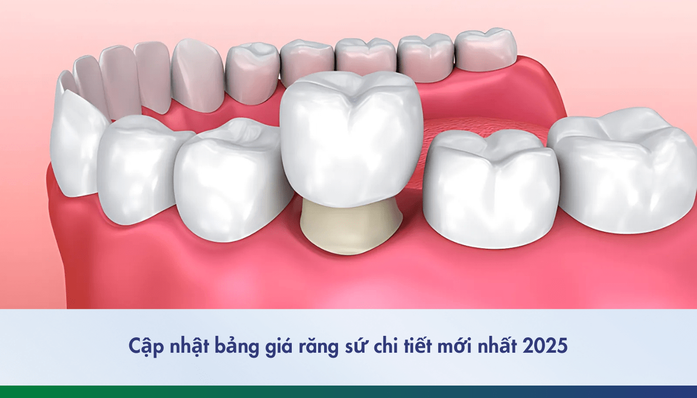 Cập nhật bảng giá răng sứ 2025