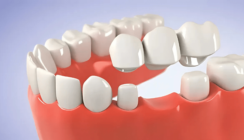 Làm cầu răng sứ