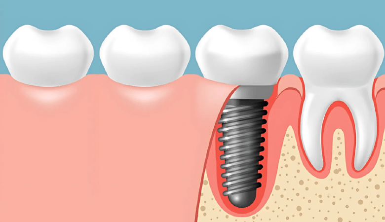 Chi phí làm răng sứ