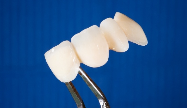 Chi phí làm răng giả bằng phương pháp cầu sứ