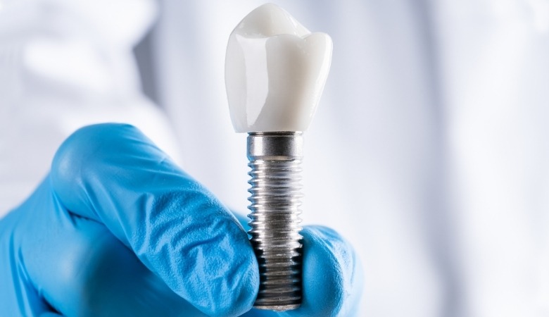 Chi phí làm răng giả bằng phương pháp implant