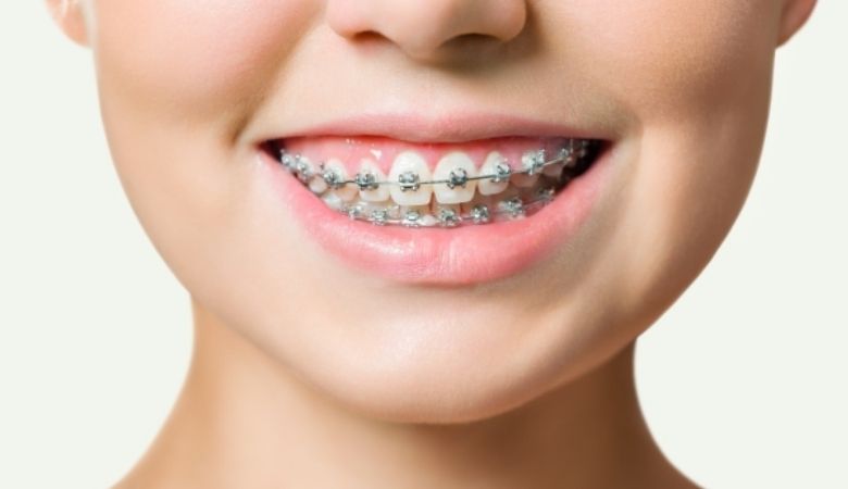 niềng răng thứ còn bao gồm giảm nguy cơ sâu răng và các bệnh lý nha chu do răng thưa gây ra