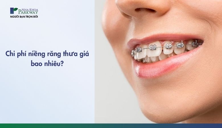 Niềng răng thưa là phương pháp chỉnh nha hiệu quả