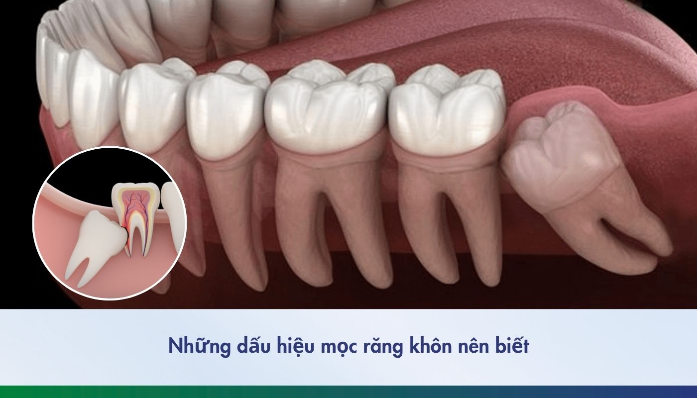 Những dấu hiệu mọc răng khôn nên biết