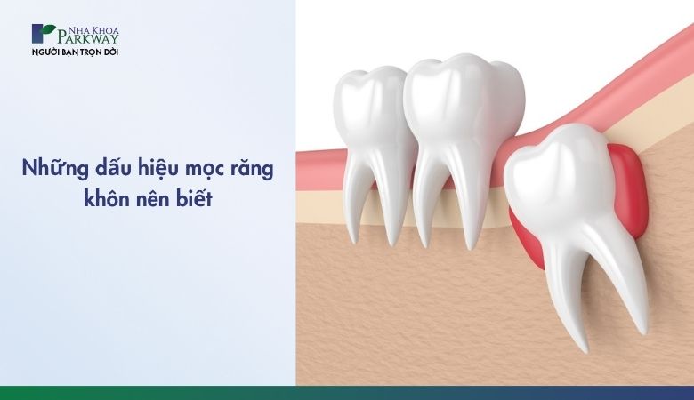 Những dấu hiệu mọc răng khôn nên biết