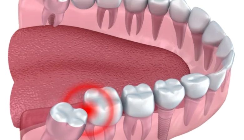 mọc răng khôn thường đi kèm các triệu chứng khó chịu