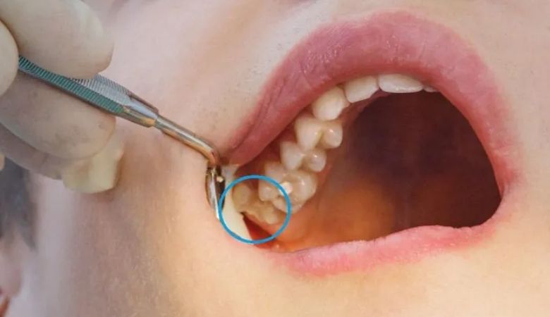 Những biểu hiện mọc răng khôn bất thường cần đi khám ngay